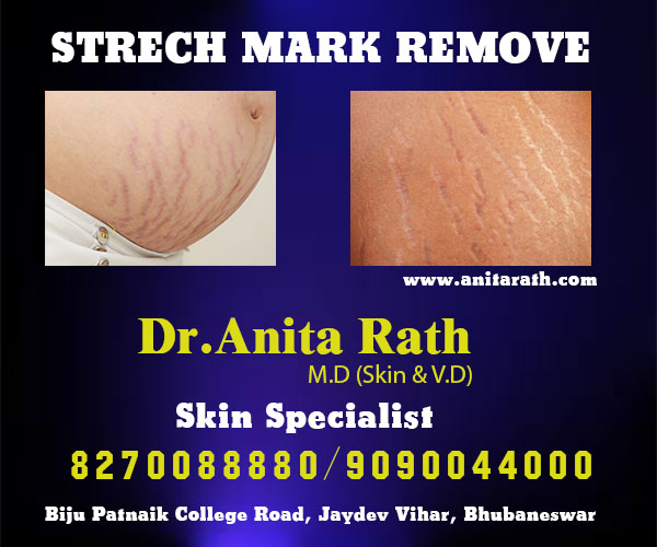 Best stretch mark remove clinic in bhubaneswar, odisha